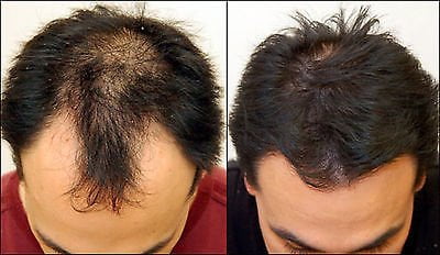 Buy Hair Loss Treatment Product Serum Malaysia
